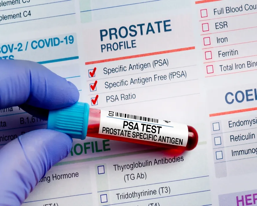 PSA Testi: Prostat Sağlığı İçin Önemi, Normal Değerleri