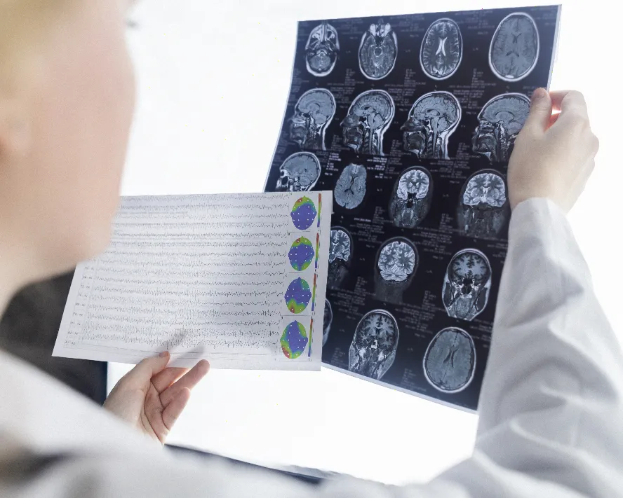 Epilepsi (Sara Hastalığı): Nedenleri, Belirtileri ve Tedavi Yöntemleri