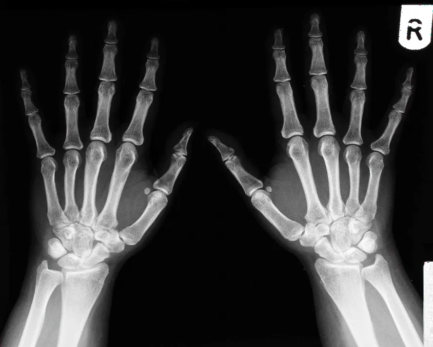 Skafoid Kırığı Nedir?