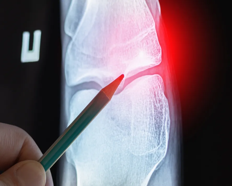 Osteoid Osteoma Tümörü Nedir?