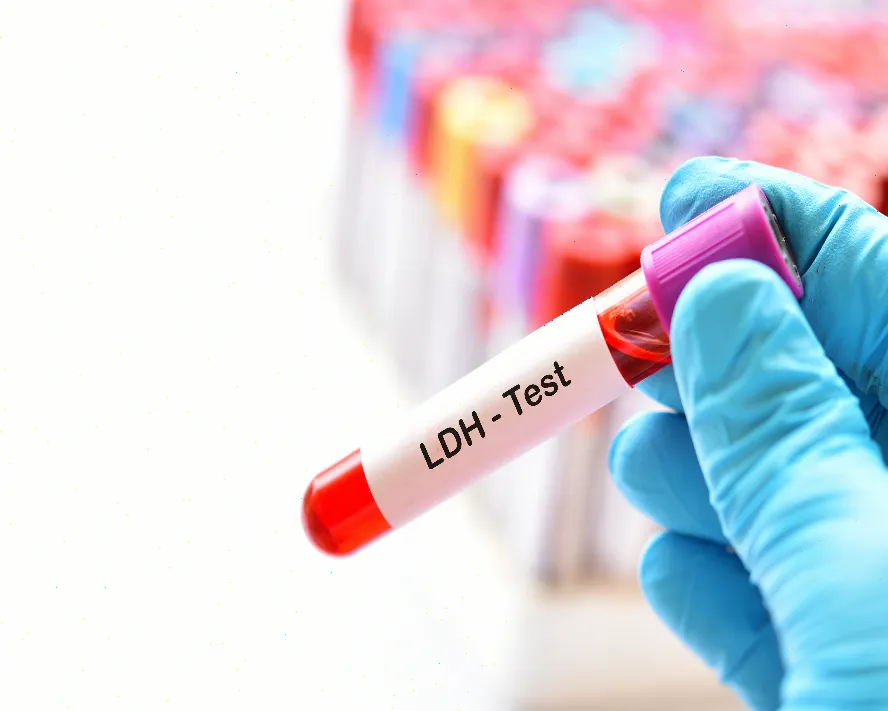Laktat Dehidrogenaz (LDH) Testi: Yükseklik ve Düşüklük Ne Anlama Gelir?