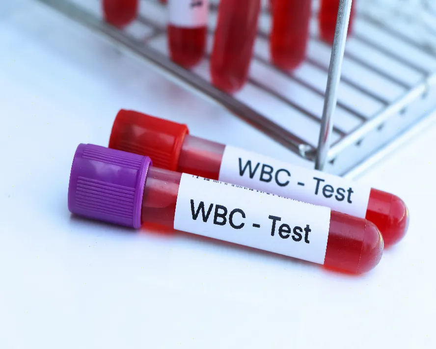 WBC Yüksekliği Nedir? Belirtileri ve Nedenleri Nelerdir?