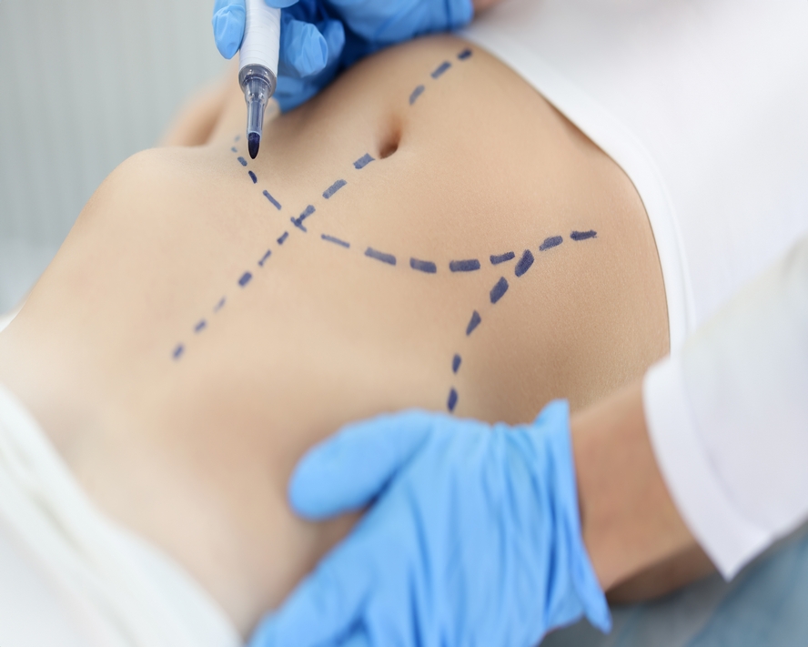 Liposuction: Vücut Şekillendirme Hakkında Bilmeniz Gerekenler