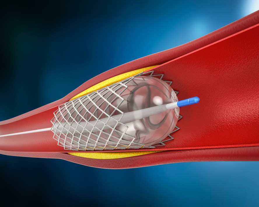 Mitraclip Nedir