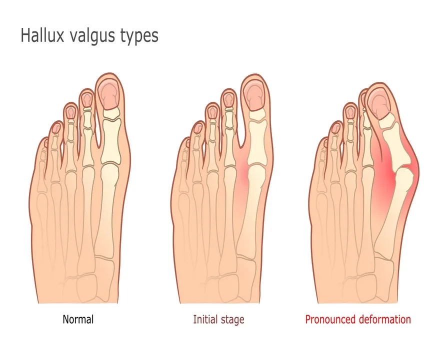 Halluks Valgus (Ayakta Başparmak Çıkıntısı) Nedir?