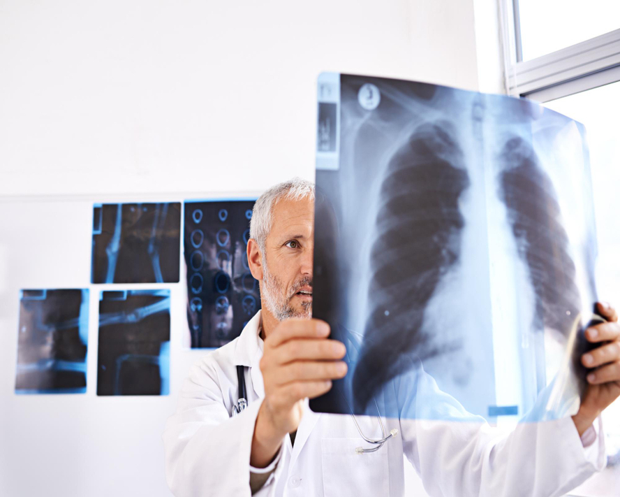 Kistik Fibrozis Nedir? Belirtileri, Nedenleri ve Tedavi Yöntemleri