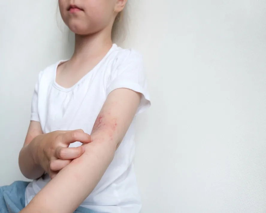 Seboreik Dermatit: Belirtileri, Nedenleri ve Güncel Tedavi Yöntemleri