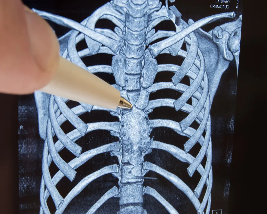 Timus Bezi Tümörleri Nedir?