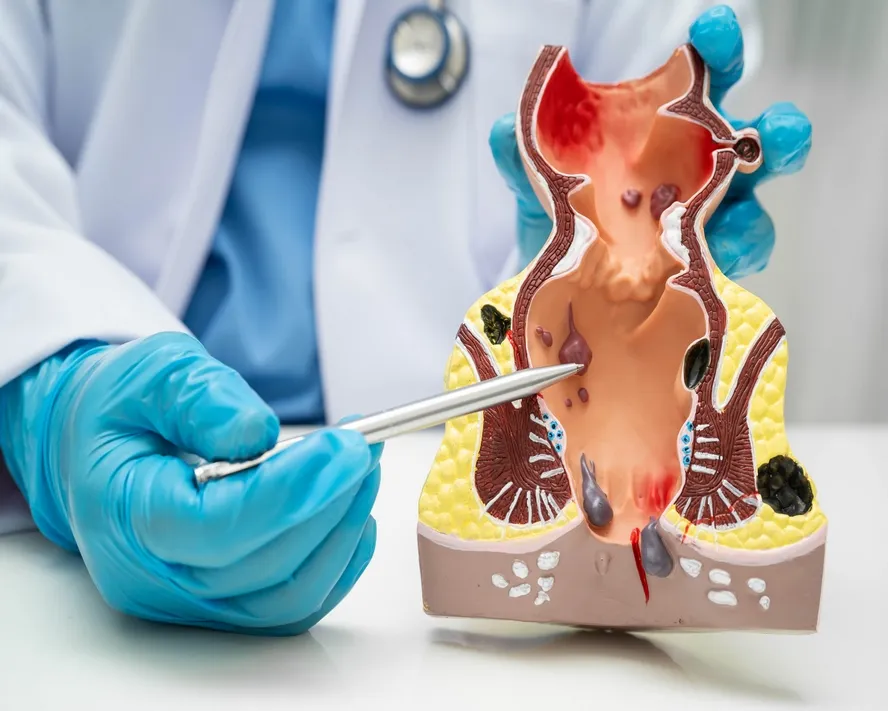 Hemoroid (Basur) Nedir? Neden Olur? Basura Ne İyi Gelir?